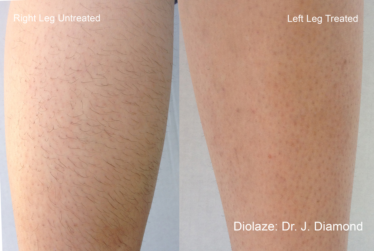diolaze laser hair removal reviews